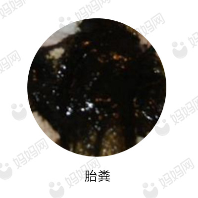 宝宝拉这几种便便要去医院,宝宝有问题的便便是怎样的