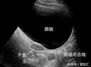 28岁临床诊断闭经怎么办,病例分析原发闭经的诊断思路