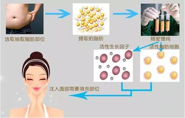 脂肪移植术后需要注意什么,自体脂肪移植填充泪沟多久恢复