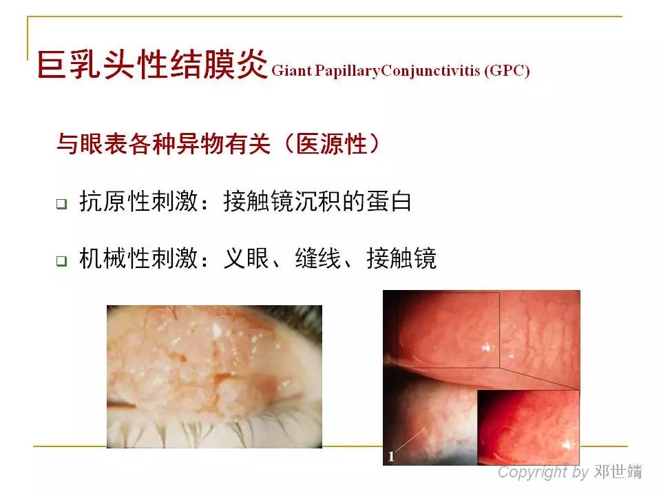 眼睛过敏如何预防,治疗眼周围过敏方法