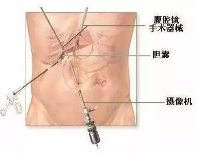 一招判断是胃疼还是胆囊炎,怎样快速缓解胆囊引起的胃疼