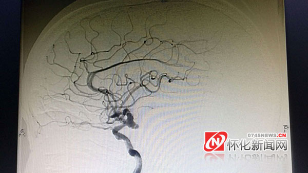 脑袋动脉瘤破裂大面积出血,头痛一下突然很慌担心脑出血