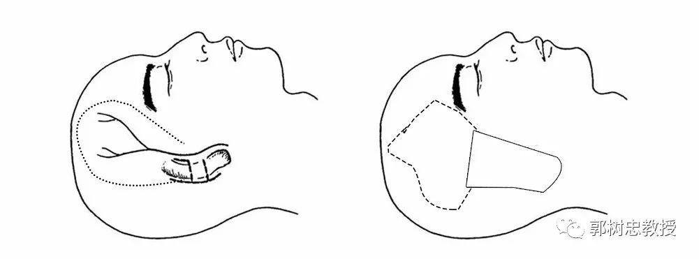 耳再造全过程,造耳朵技术
