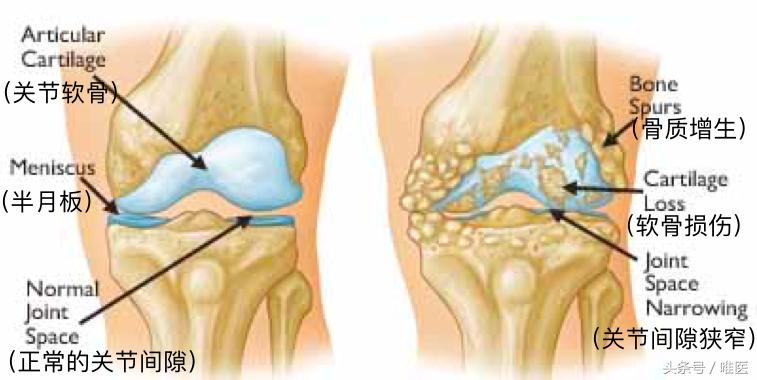 膝关节炎防治知识你了解多少呢,膝关节炎100问科普版