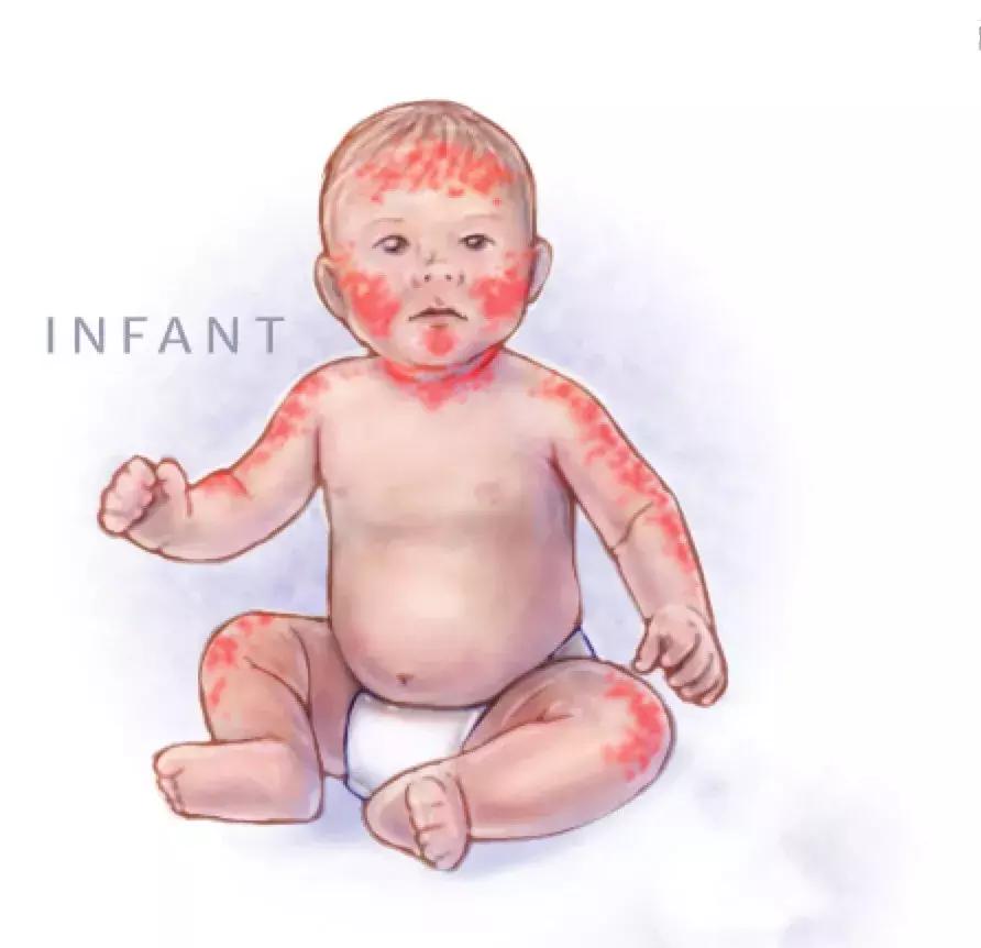 宝宝湿疹反反复复难治愈详细方案,宝宝湿疹反反复复该怎么办