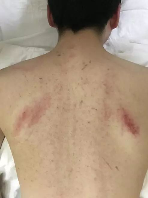 阿娇刮痧后背效果,阿娇背部刮痧图片
