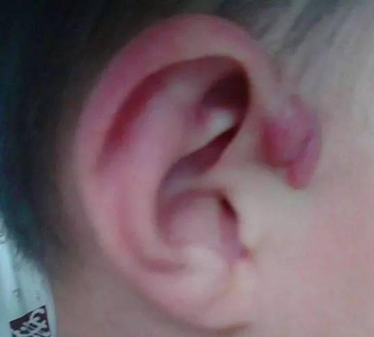 孩子耳朵长肉芽还流脓必须手术么,富贵包流血流脓是怎么回事