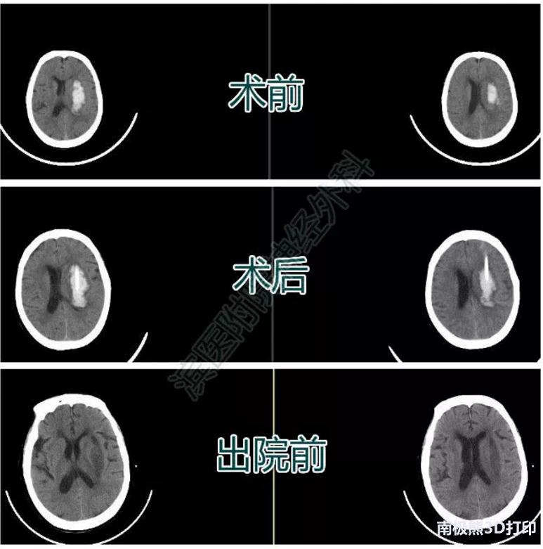 医学3d动画演示脑出血手术,3d演示脑出血治疗过程