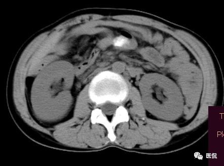 手术纱布遗留在体内可以吸收吗,手术纱布忘了取出会怎样