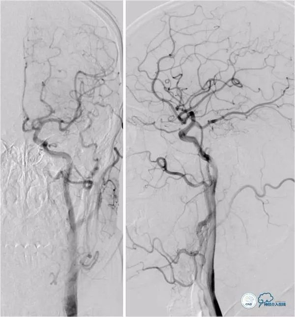 天坛医院做椎动脉狭窄多少要手术,天坛椎动脉狭窄