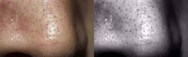 长痘痘怎么才能不留印,长痘痘了怎么消除不留疤