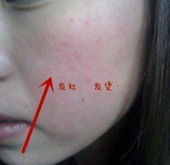 敷面膜过敏脸上满脸疙瘩怎么消除,别再乱敷面膜了敷对时机很重要