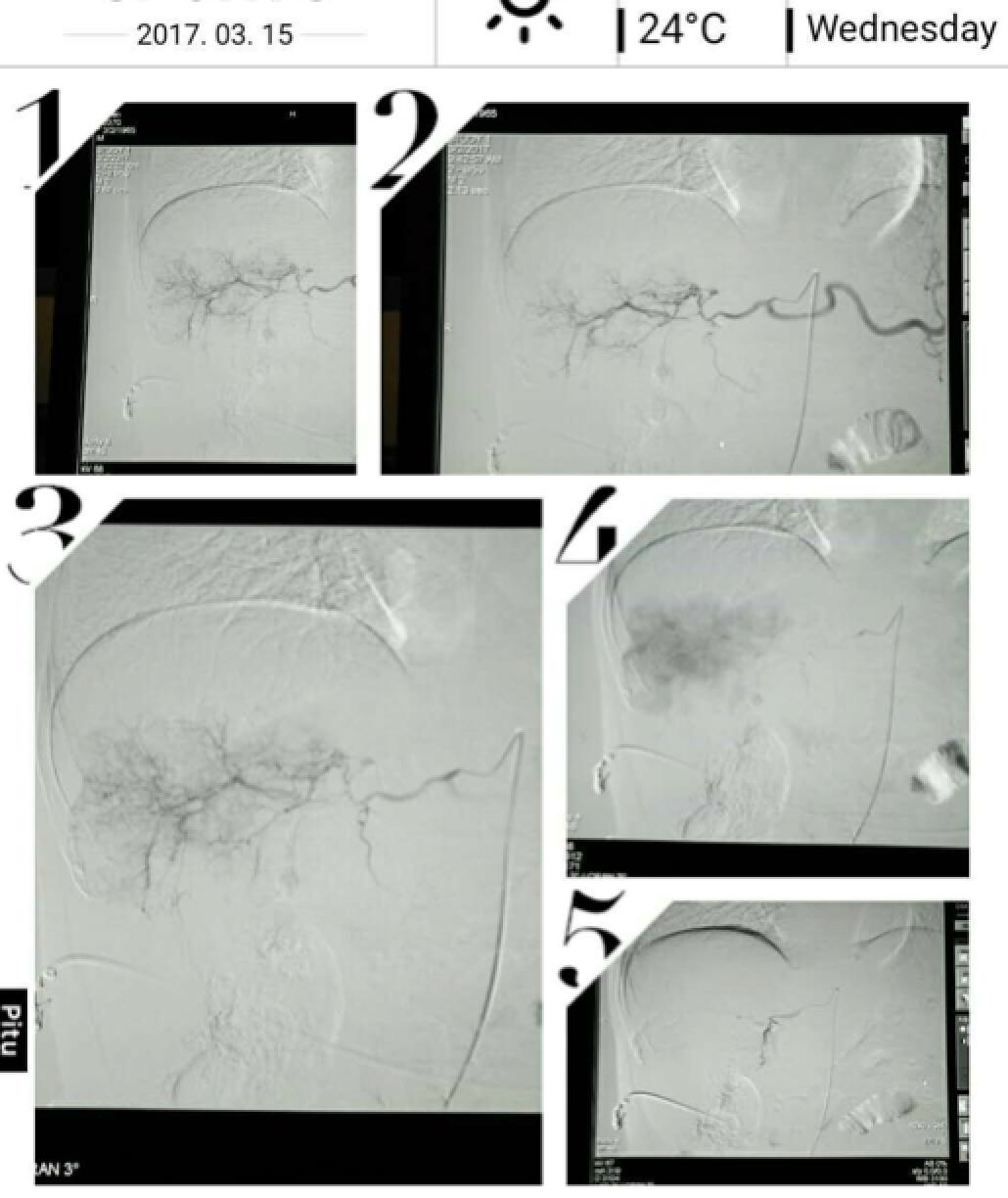 周仲国评价肝癌病例,周仲国分享肝癌早期复发
