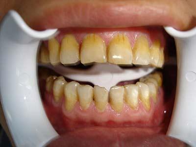 每天刷牙牙齿还是发黄是怎么回事,饮用含氟量过大的水导致牙齿发黄