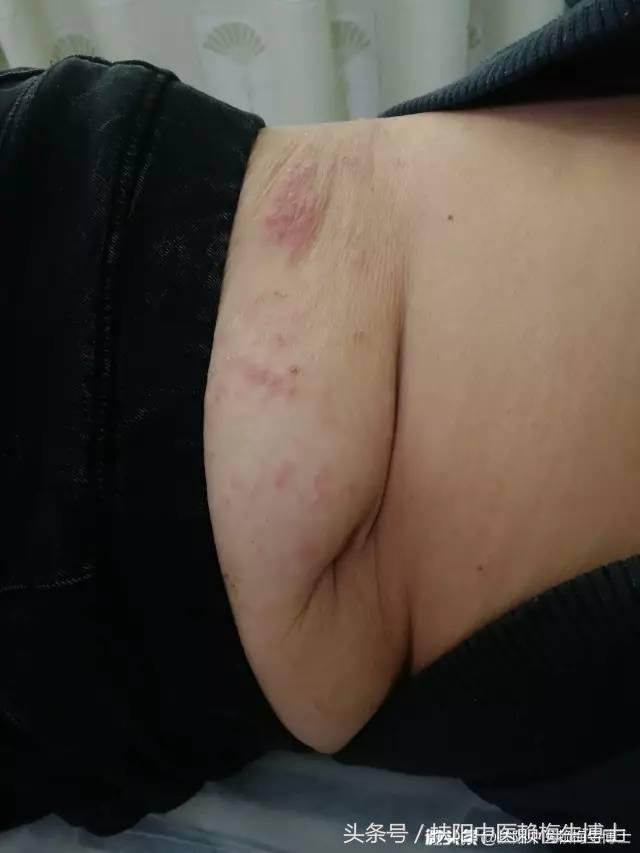 内针治疗带状疱疹剧烈疼痛4例分析