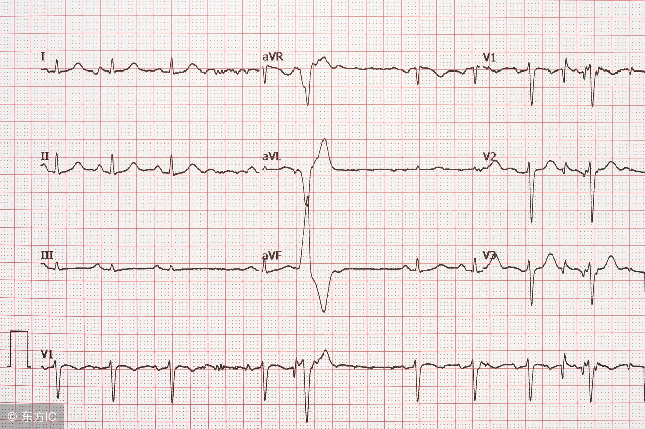 心电图偶发性房颤,什么是一过性房颤