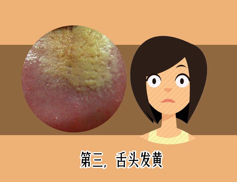 舌苔发黑辨证,舌苔发青警惕四种原因