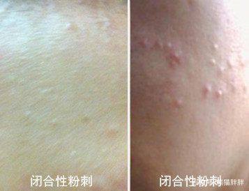 闭口肤质怎么改善,长闭口的正确消除方法