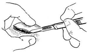 皮脂腺囊肿切除术多少钱,皮脂腺囊肿切除术