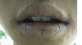 嘴角干燥脱皮性唇炎,干燥性的唇炎是慢性唇炎吗