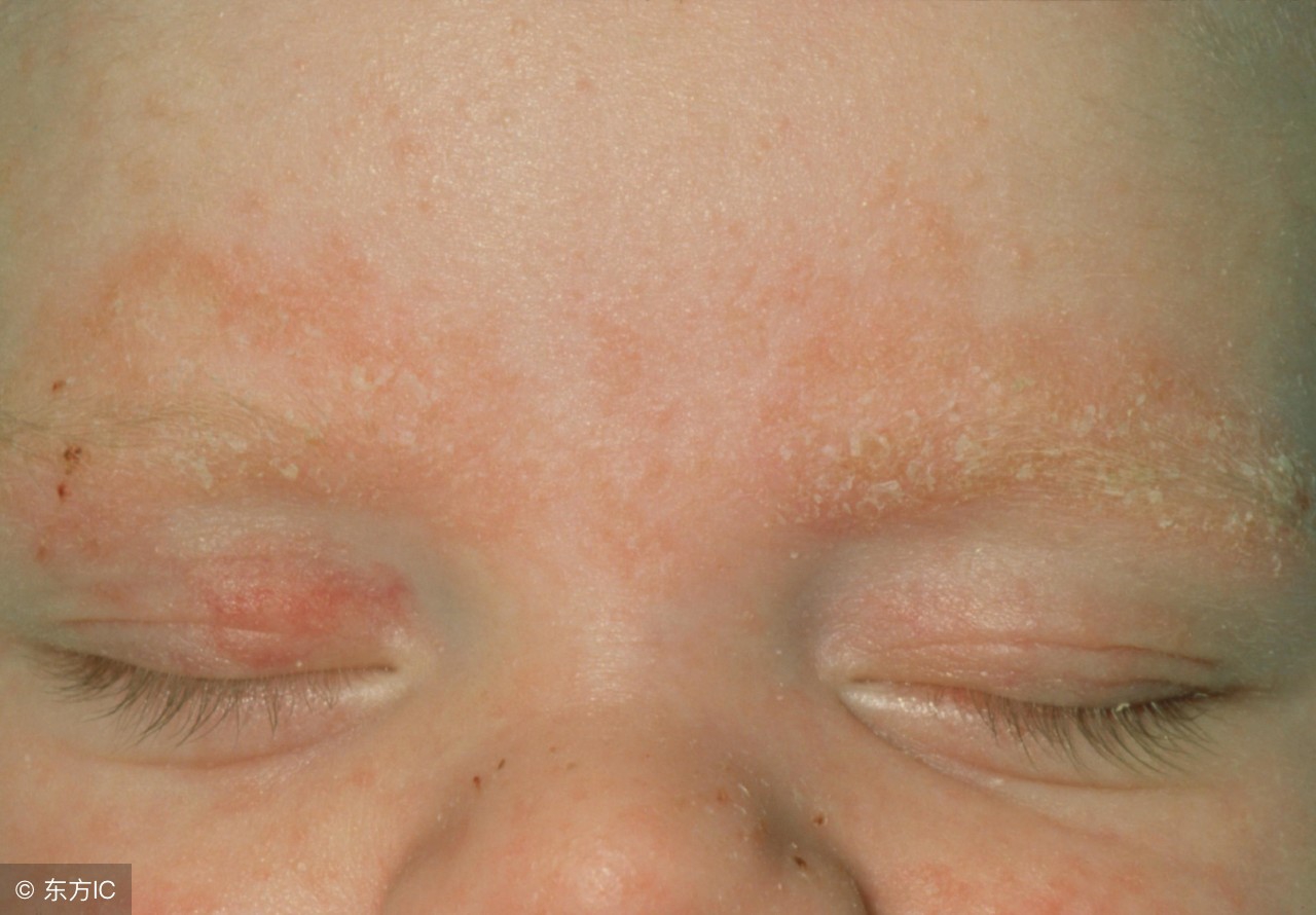 与湿疹抗战三载，四个湿疹“后遗症”并没想象中那么可怕