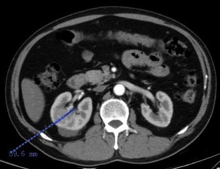 培唑帕尼和阿昔替尼哪个治肾癌好,阿昔替尼能治疗肾癌转移肝肺吗