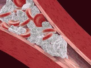 治血栓的民间配方最新,预防血栓食谱一览表