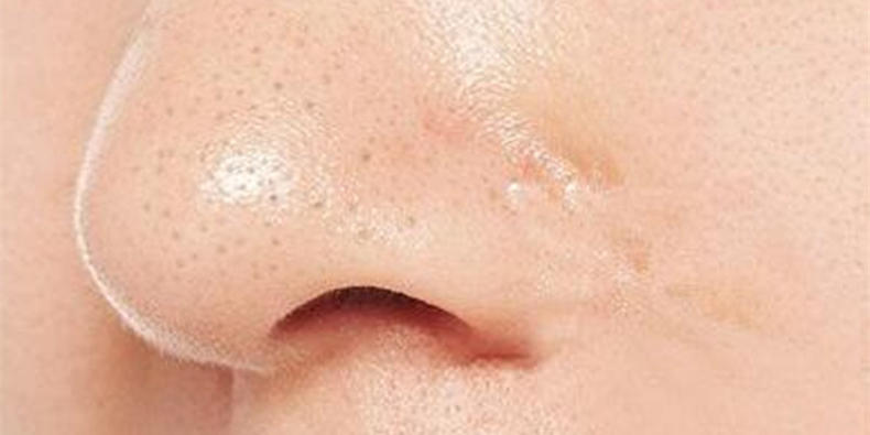 黑头既恐怖又恶心，教你四招打败黑头君