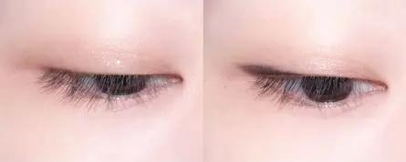 单眼皮适合割什么双眼皮,单眼皮不想割双眼皮有什么办法