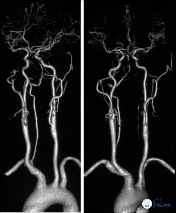 天坛医院做椎动脉狭窄多少要手术,天坛椎动脉狭窄