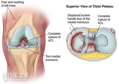 骑行膝盖疼一招搞定,骑行膝盖疼还能骑吗