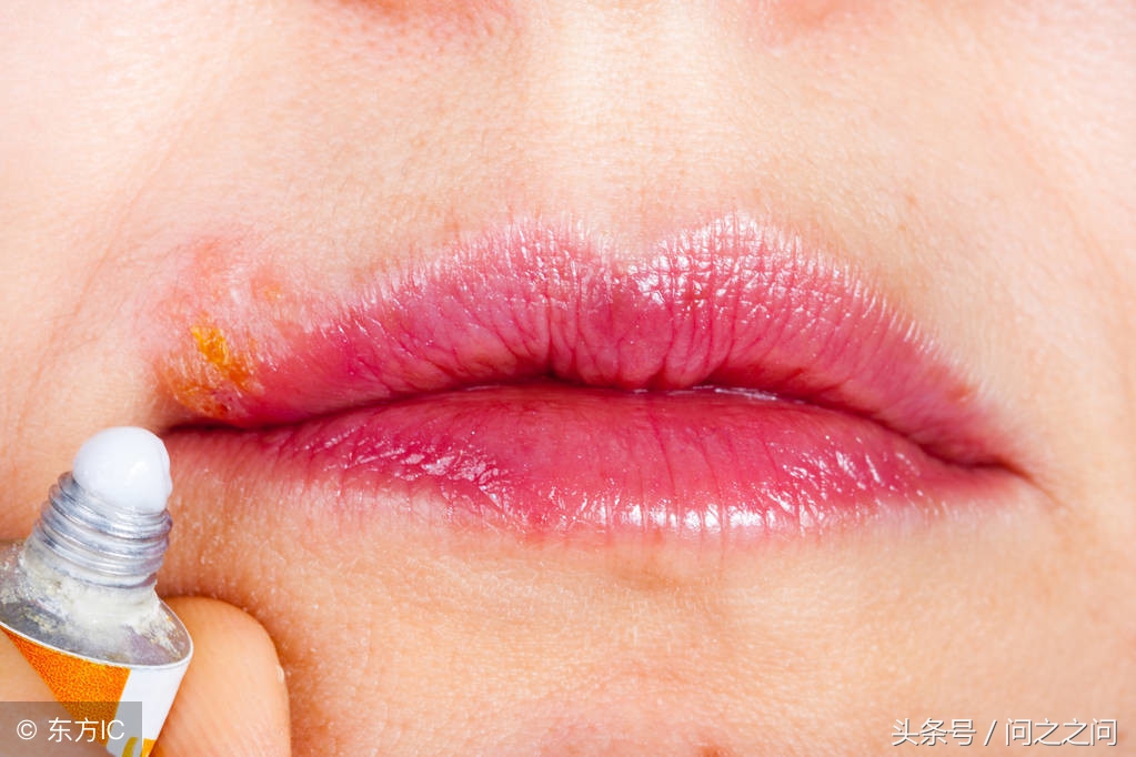 hsv病毒和疱疹的区别是什么,单纯疱疹病毒hsv1是什么