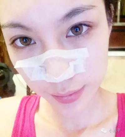 顽固草莓鼻怎么改善,消除草莓鼻的最快方法美容院