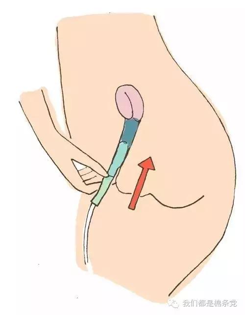 棉条不好塞怎么办,棉条没有导管放不进去怎么办