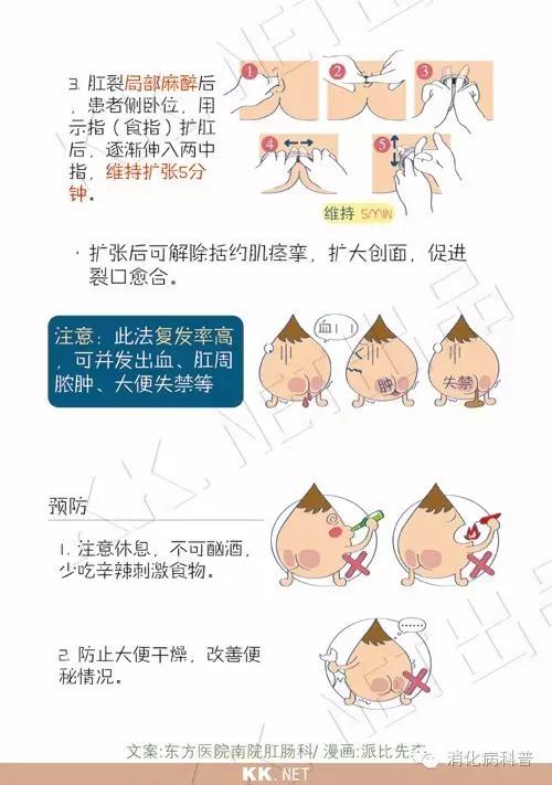 难以启齿的肛裂是怎么回事