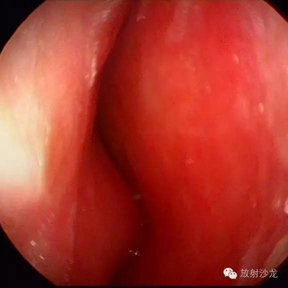 巨细胞性肉芽肿治疗费用,颌骨巨细胞修复性肉芽肿x线表现