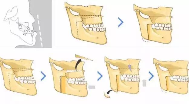 宝宝牙齿地包天是什么情况,宝宝牙齿地包天是怎么造成的