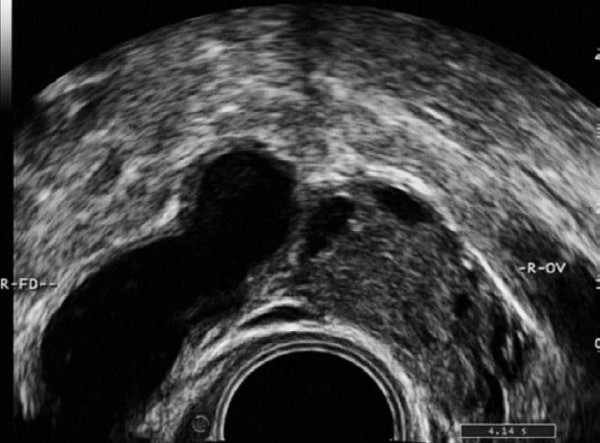 医学微视慢性盆腔炎,2023年盆腔炎检查报告单图片