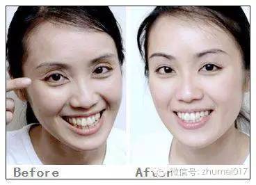 脸上部分凹陷,年龄增长脸颊凹陷