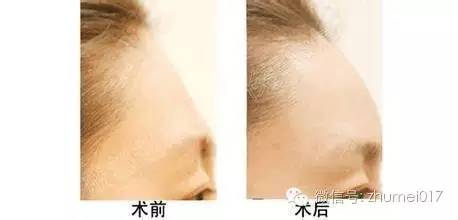 脸上部分凹陷,年龄增长脸颊凹陷