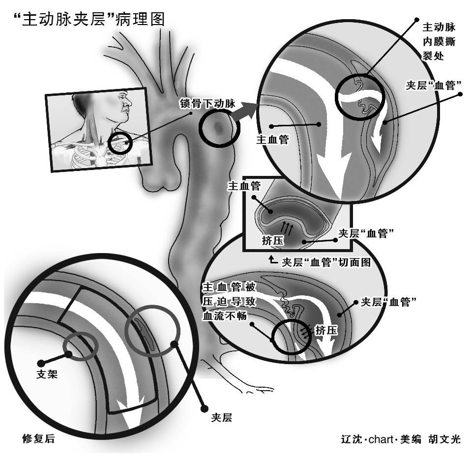 美国治疗主动脉夹层,倪海厦治疗主动脉夹层