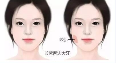 关于瘦脸针的几个常识问题,解密瘦脸针的几大常识性问题