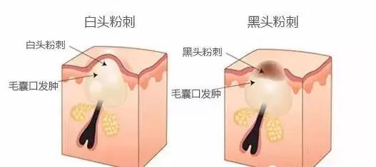 为什么粉刺不挤也有印子,为什么粉刺老是挤不干净