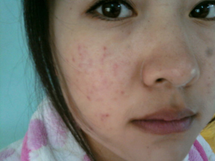 激素依赖性皮炎怎么治疗能彻底,激素依赖性皮炎最好的治疗方法