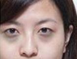 黑眼圈缺少什么,黑眼圈是什么原因造成的怎么调理