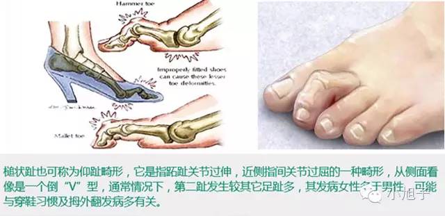 高跟鞋太高穿累脚怎么办,高跟鞋穿了不磨脚怎么办