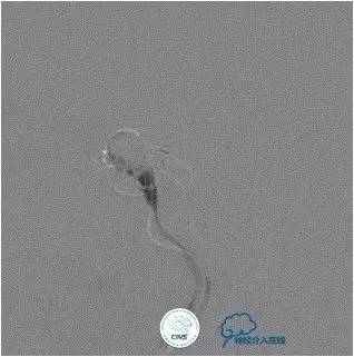 球囊辅助Onyx栓塞治疗硬脑膜动静脉瘘（DAVF）
