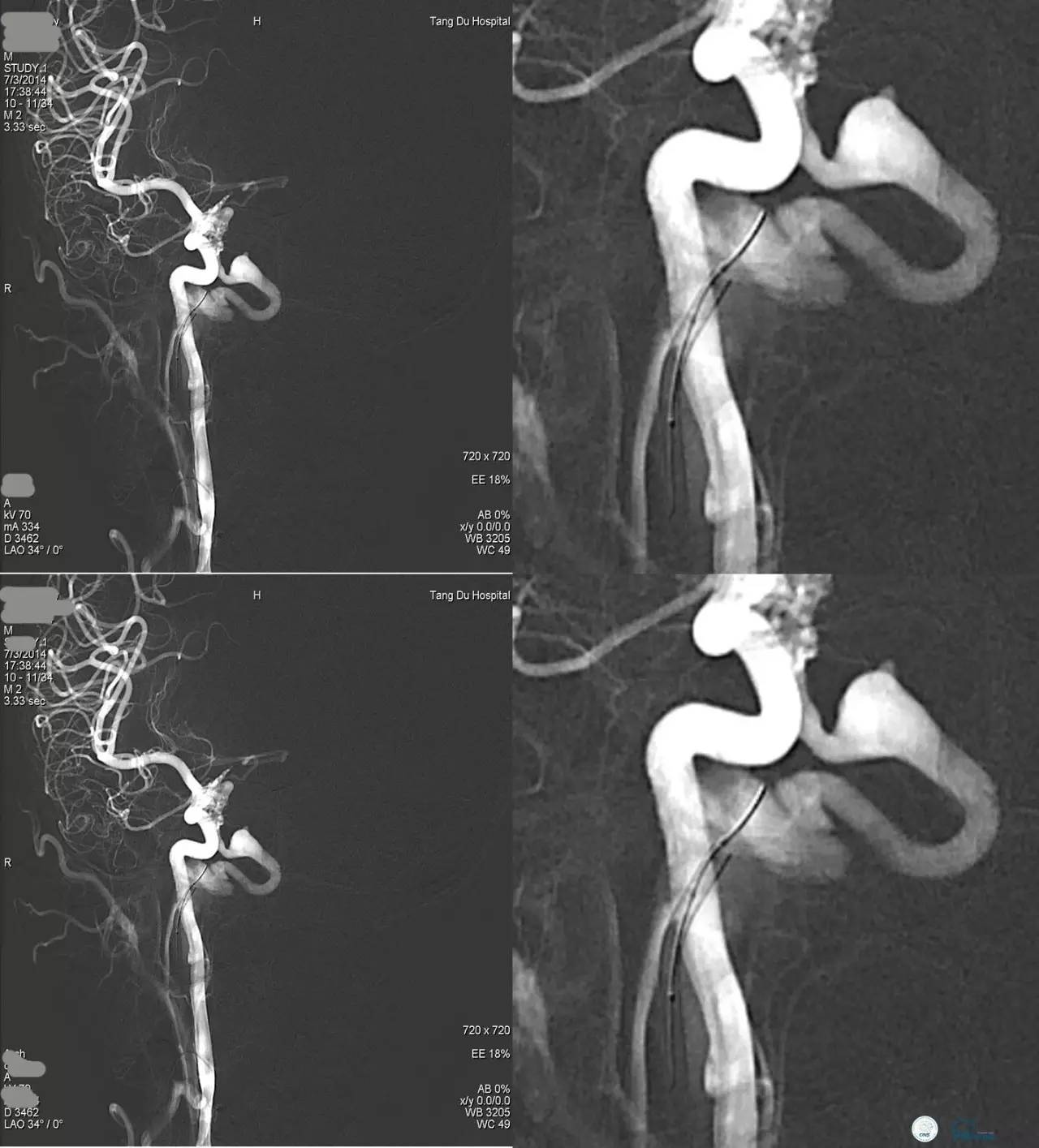 球囊辅助Onyx栓塞治疗硬脑膜动静脉瘘（DAVF）