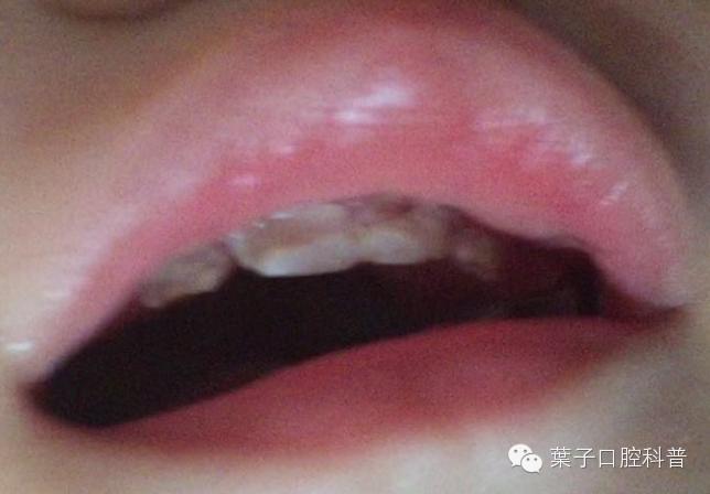 宝宝牙釉质脱落严重怎么办,宝宝牙齿牙釉质脱落涂氟还管用吗