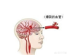 老年人预防脑出血最佳方法,预防脑出血针灸的最佳穴位